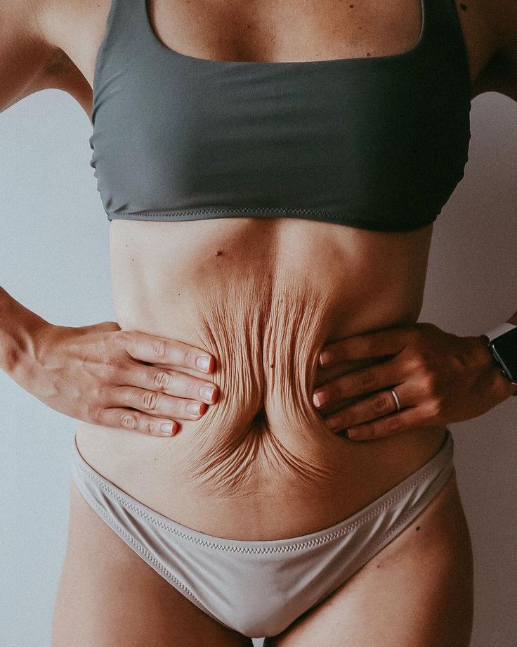 Bioestimulador de Colágeno Corporal HaCa