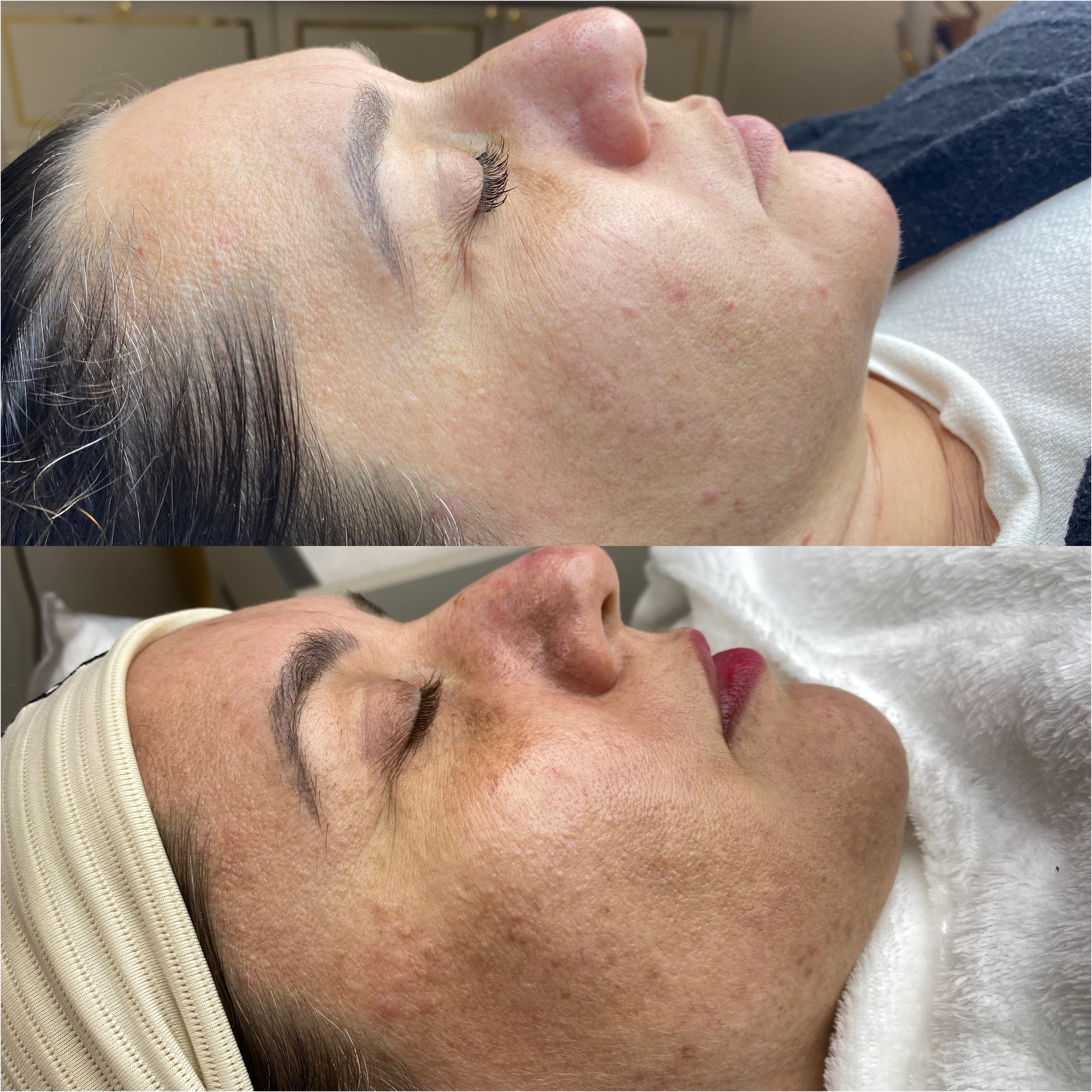 Peeling Químico