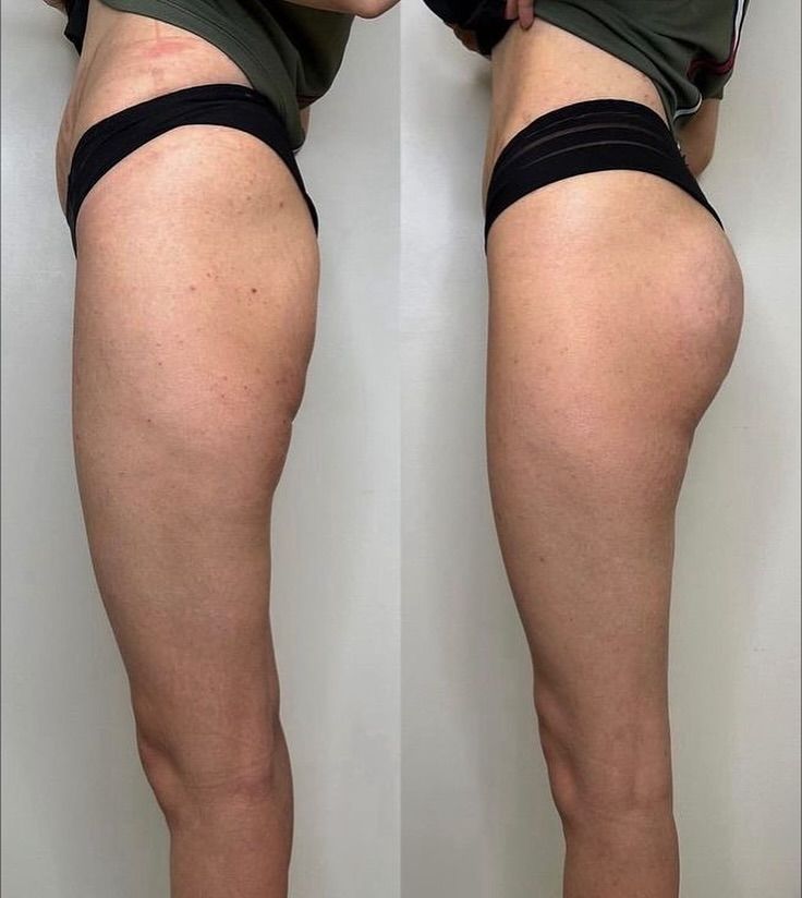 Preenchimento de Glúteos por ml
