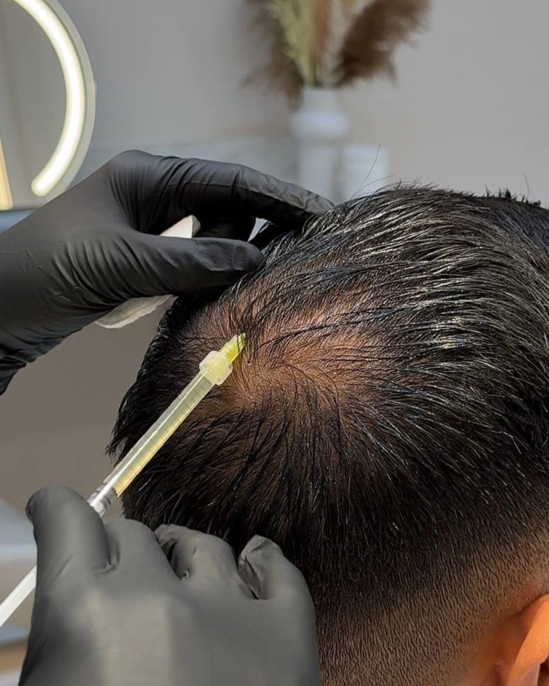 Intradermoterapia Capilar