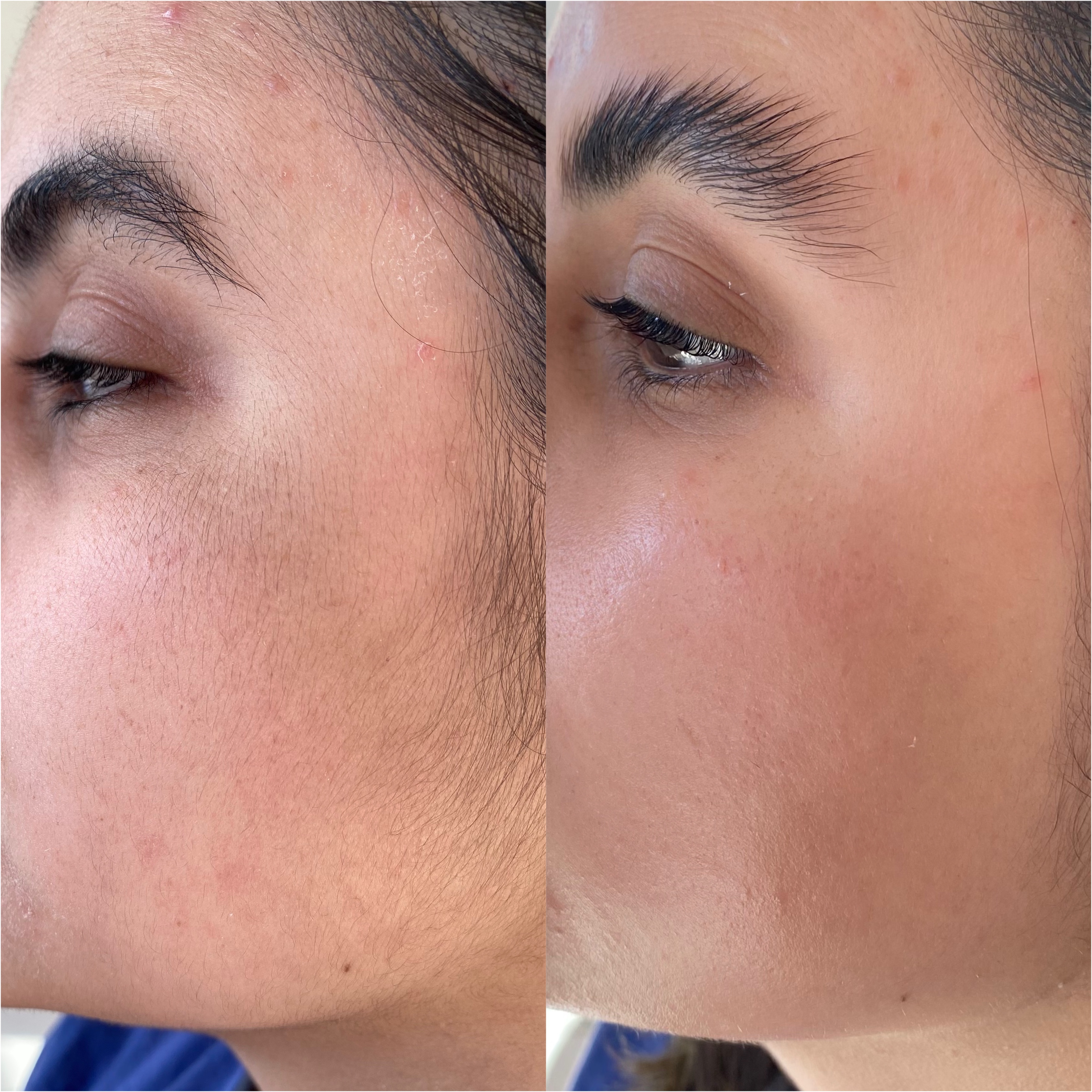 Dermaplaning